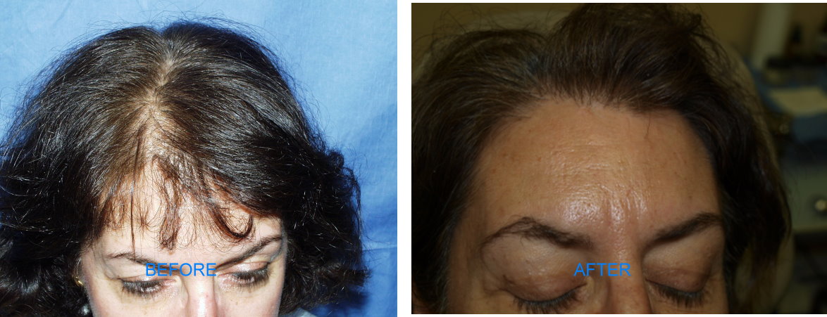 Follicular Unit Hair Transplant (Before & After)