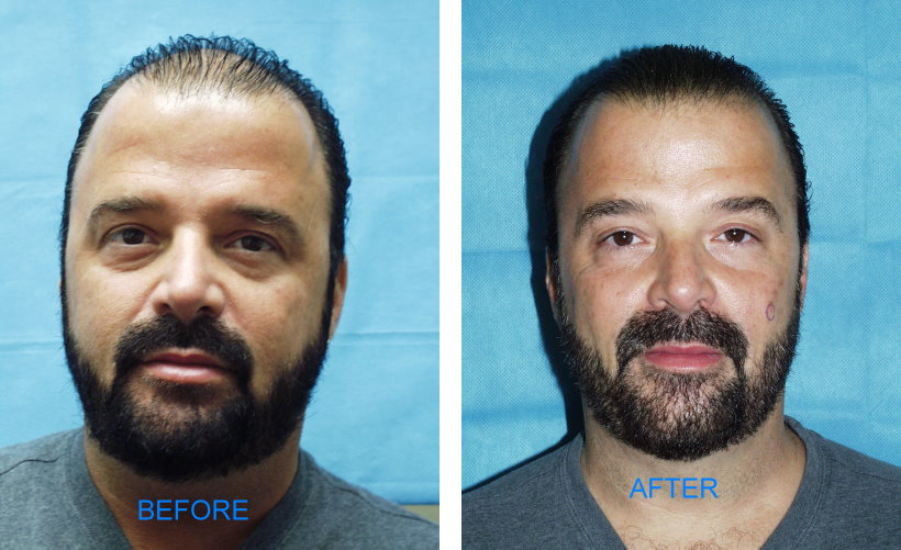 Follicular Unit Hair Transplants (Before & After)