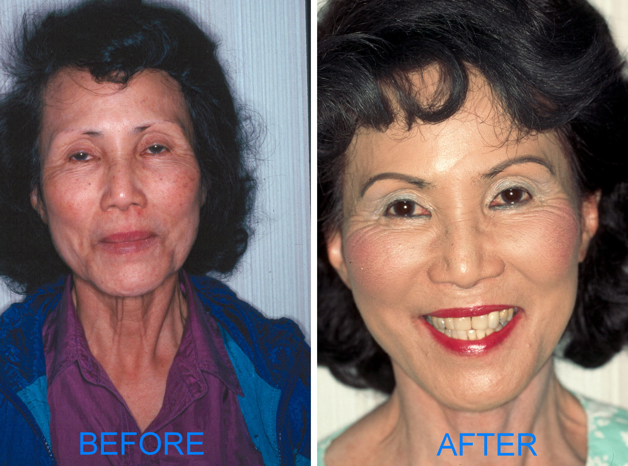 Facelift (Before & After) Frontal