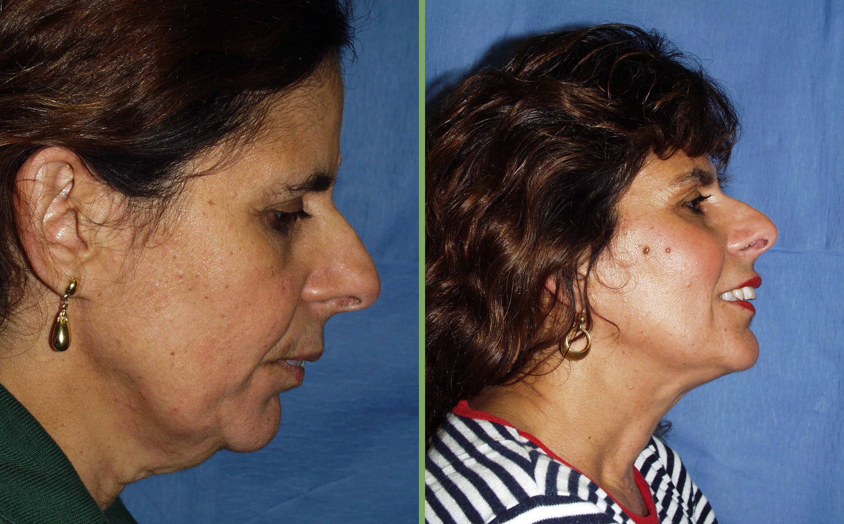 Neck Liposuction (Before & After)