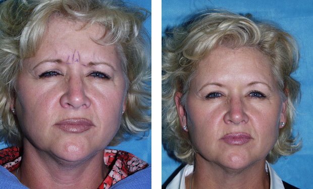Botox ( to glabellar frown lines) Before and @ 6d