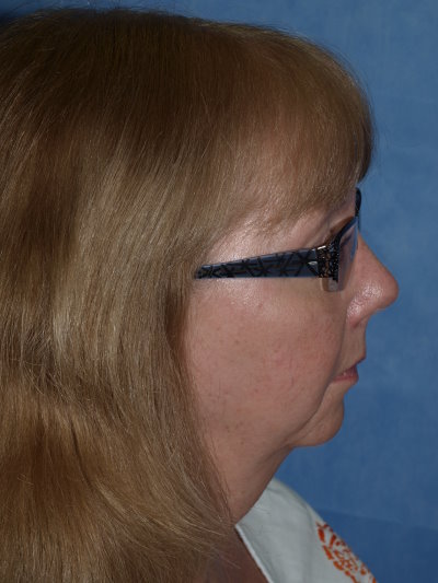Chin Implant, Before-Lateral View