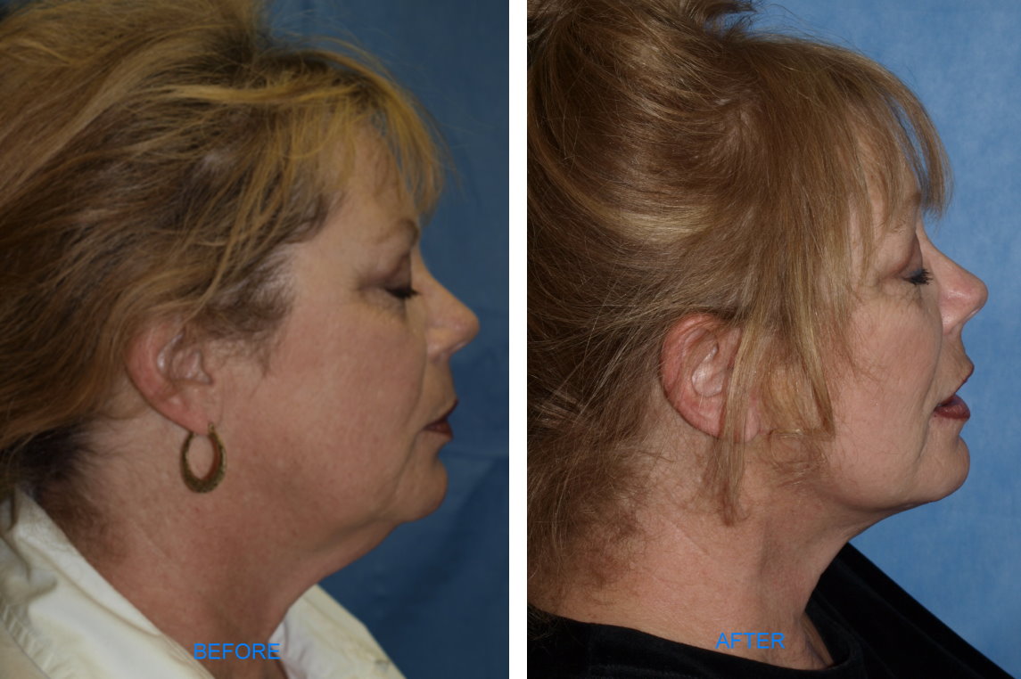 S-Lift (Before & After, Lateral)